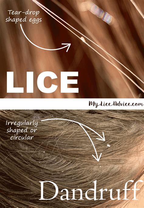 Lice vs dandruff 7 key differences between lice eggs and dandruff – Artofit