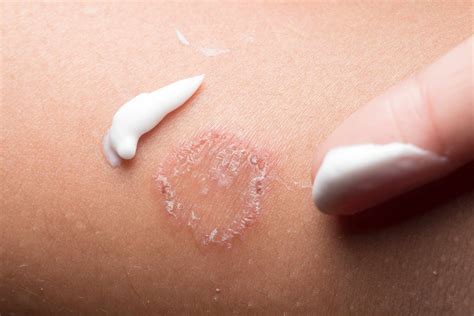 Circular Rash: Symptoms, Causes, and Treatment