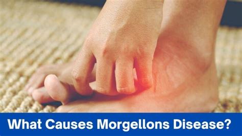 What Causes Morgellons Disease? Beyond Skin Deep » 2024