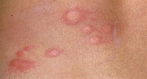 Papular urticaria | BabyCenter