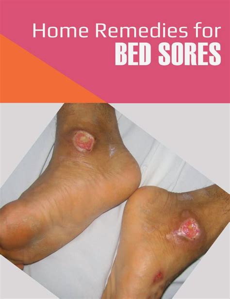 Home Remedies For Bed Sores | Tips Park