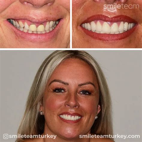 Turkey Teeth Before After Photos | Smile Team Turkey