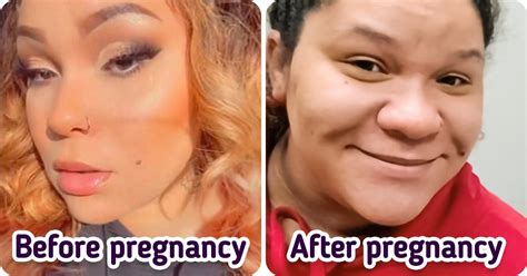 “2 Different People”: Woman, 24, Gets Extreme “Pregnancy Nose” and ...