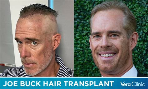 Joe Buck Hair Transplant: Involving Hair Plugs