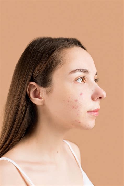 Acne Scars, PIH And PIE - Free Bunni