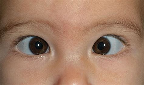 Strabismus causes, symptoms, diagnosis, strabismus treatment & surgery