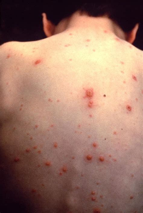 Photos of Chickenpox | Chickenpox (Varicella) | CDC