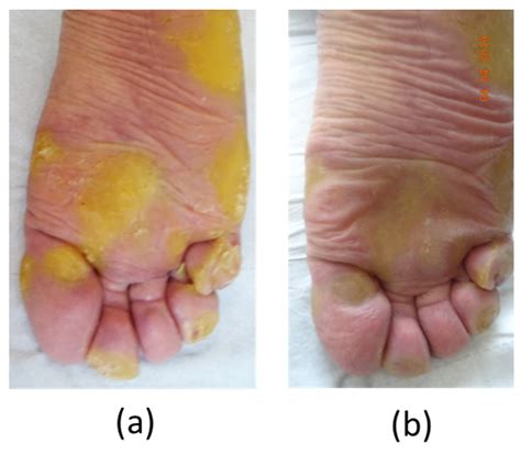 Biomedicines | Free Full-Text | Treatment of Painful Palmoplantar ...