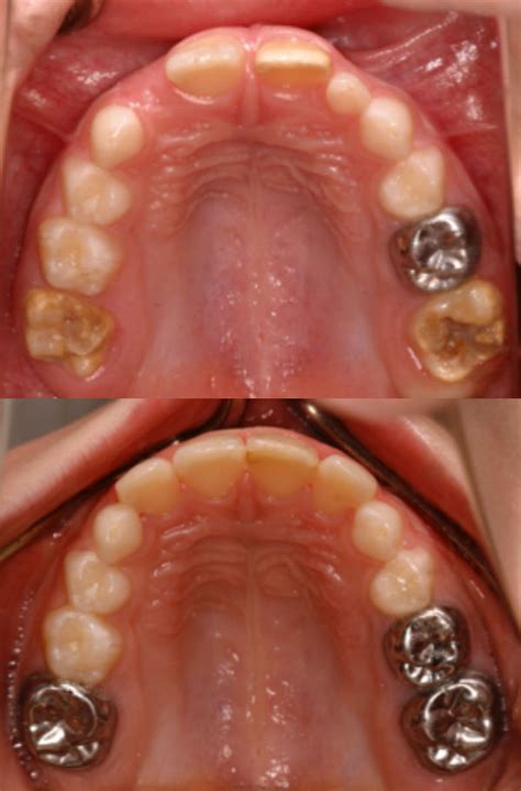 Tooth Enamel Defects Clayton - 3 Fixes | Clarinda Clinic