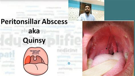 Quinsy ( Peritonsillar abscess) | E.N.T - Throat | Meddysimplified - YouTube