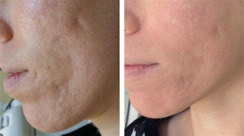 Acne Scar Treatment Norfolk, VA – Edgewater Aesthetics | The Premier Norfolk Med Spa