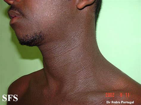 Acanthosis nigricans - wikidoc