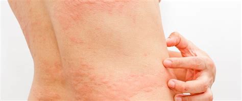 Cold Urticaria: Symptoms, Causes, And How To Treat Being Allergic To ...