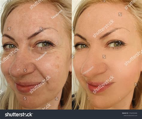 242 Cheek Filler Before And After Images, Stock Photos & Vectors | Shutterstock