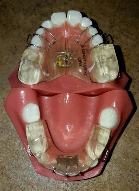 Twin Block | Orthodontic appliances, Dental fun, Orthodontics braces