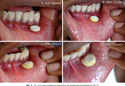 Figure 1 from Formulation and Evaluation of Bioadhesive Buccal Drug ...