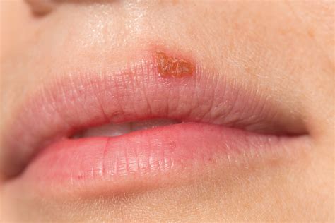 Can Cold Sores Spread In Your Mouth at Ricky Goldberg blog