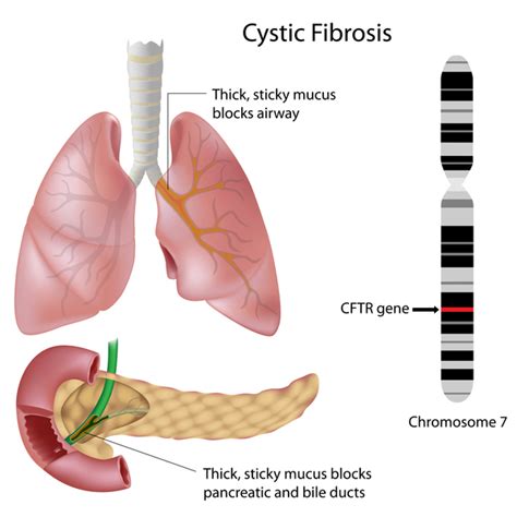 Cystic fibrosis: MedlinePlus Genetics