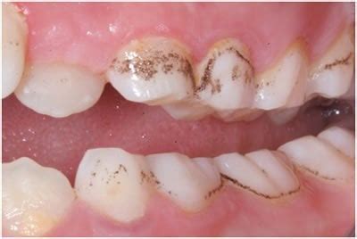 how to get rid of black stain on teeth caused by chromogenic bacteria ...