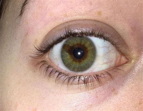 Sectoral Heterochromia: A Unique and Beautiful Eye Feature