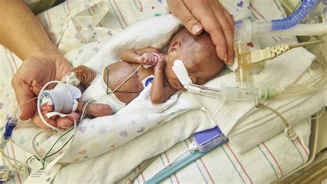 «El bebé más prematuro de la historia» con 21 semanas y sólo 0,5kg prospera tres años después ...