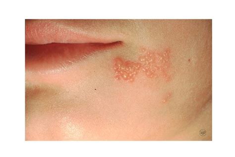 What's that Rash? How to ID Common Rash Symptoms | The Healthy