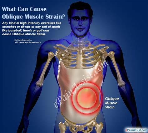 Oblique Muscle Strain|Causes|Symptoms|Treatment|Recovery