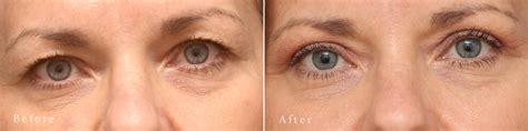 Upper Eyelid Surgery Photos | Princeton, NJ | Patient 8225