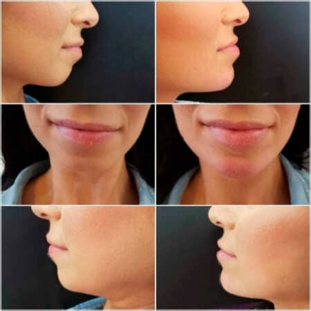 Chin-Filler-2 - Derma Medical