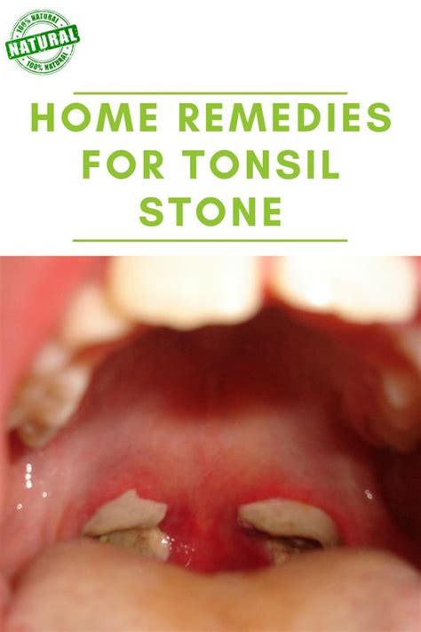 Dental Health, Dental Care, Tonsil Stones, Tonsil Stone Removal, Tonsil Removal Recovery ...