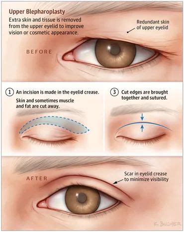 Sagging Eye Syndrome: Causes, Symptoms, Diagnosis & Treatment - Daily Medicos | Хирургия ...