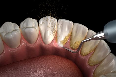 Dentist Cost Teeth Cleaning at Gertrude Townsend blog