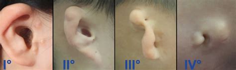 Aural atresia causes, symptoms, diagnosis, treatment & prognosis