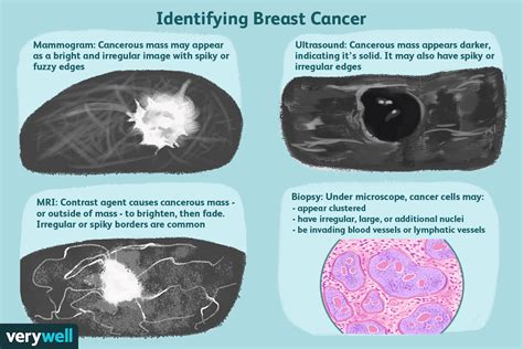 Breast Masses: Cancerous Tumor or Benign Lump?