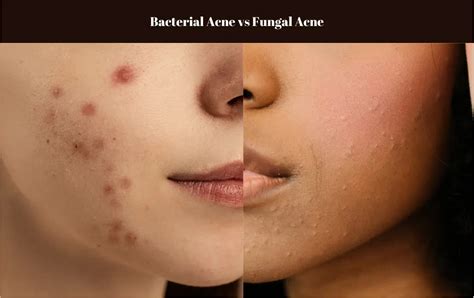 Fungal Acne vs Bacterial Acne: Identifying and Treating Different Acne Types