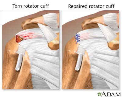 Rotator cuff repair - series—Aftercare: MedlinePlus Medical Encyclopedia