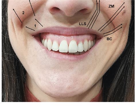 Different muscles involved during a maximum smile. The superior lip and... | Download Scientific ...