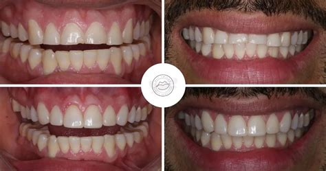 Cosmetic Dentistry: Before and After Pictures | All Smiles Dentistry