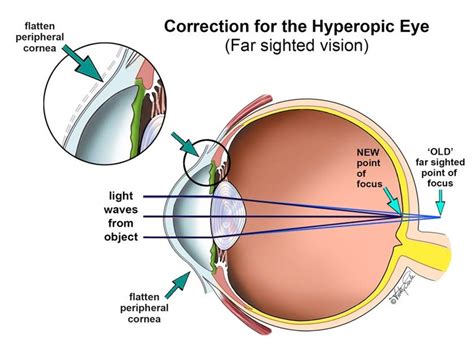 Surgery for hyperopia! | Surgery, Eye surgery, Light wave