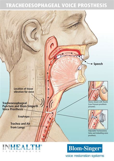 Laryngectomy | Tracheostomy Education