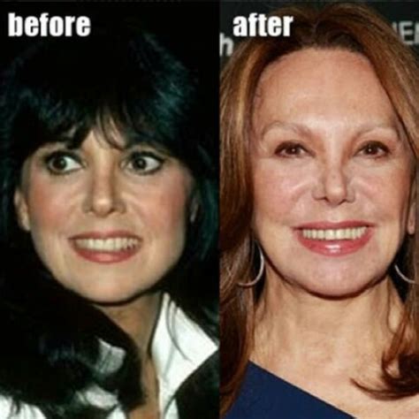 Before and After Plastic Surgery - Marlo Thomas | Celebrity plastic ...