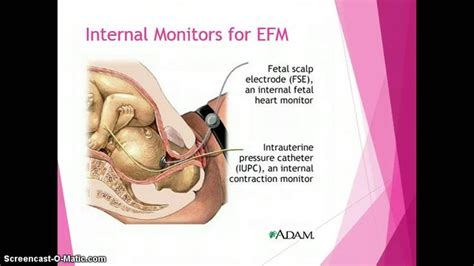 Electronic Fetal Monitoring | Fetal monitoring, Fetal, Fetal heart monitoring