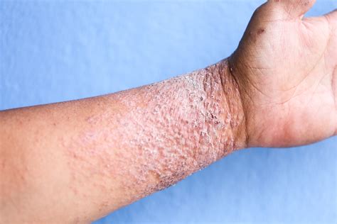 Eczema On Wrist