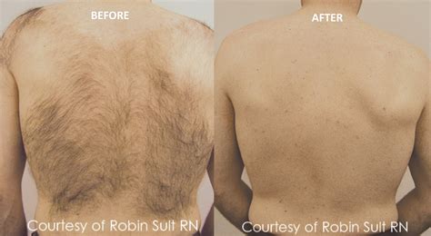 Laser Hair Removal for Men Calgary - Revive Laser