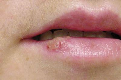 Difference Between Sunburned Lips And Cold Sores | Lipstutorial.org