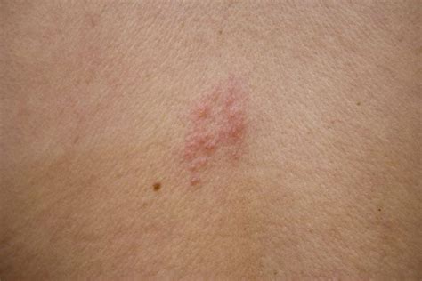 10 Signs of Shingles - Facty Health