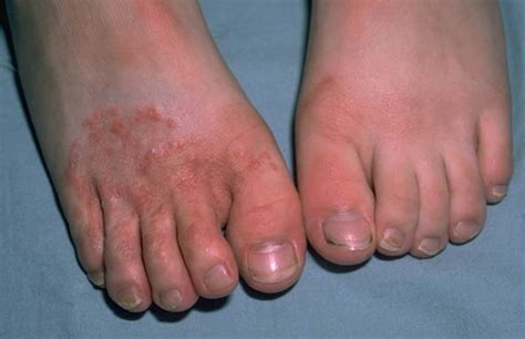 Suitable Foot Fungus Treatments