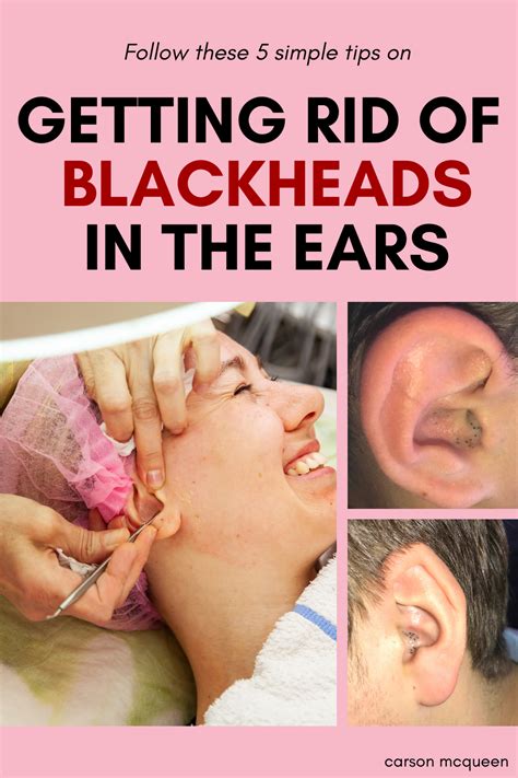 How To Remove Blackhead From Child's Ear - HOWTORMEOV