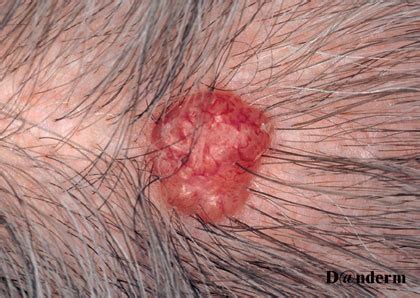 7-92 Basal cell carcinoma of the scalp