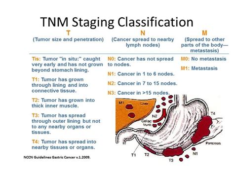 Gastric cancer - Oncology Nurse Advisor